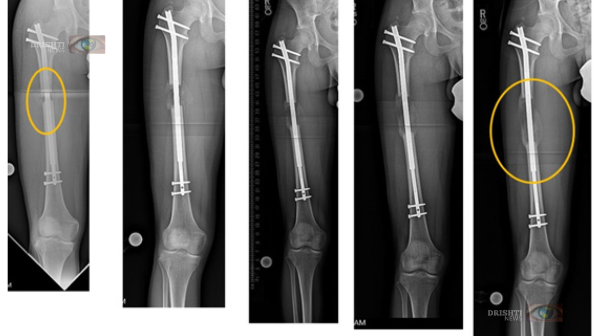 Limb-Lengthening surgery